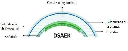 cheratoplastica Illustrazione della DSAEK