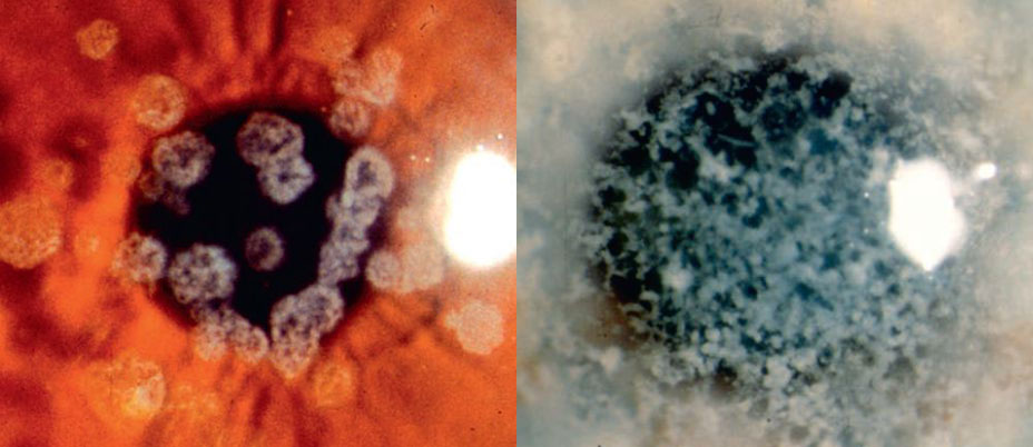 Figura 6 e 7: Distrofia granulare di tipo I (Groenow)