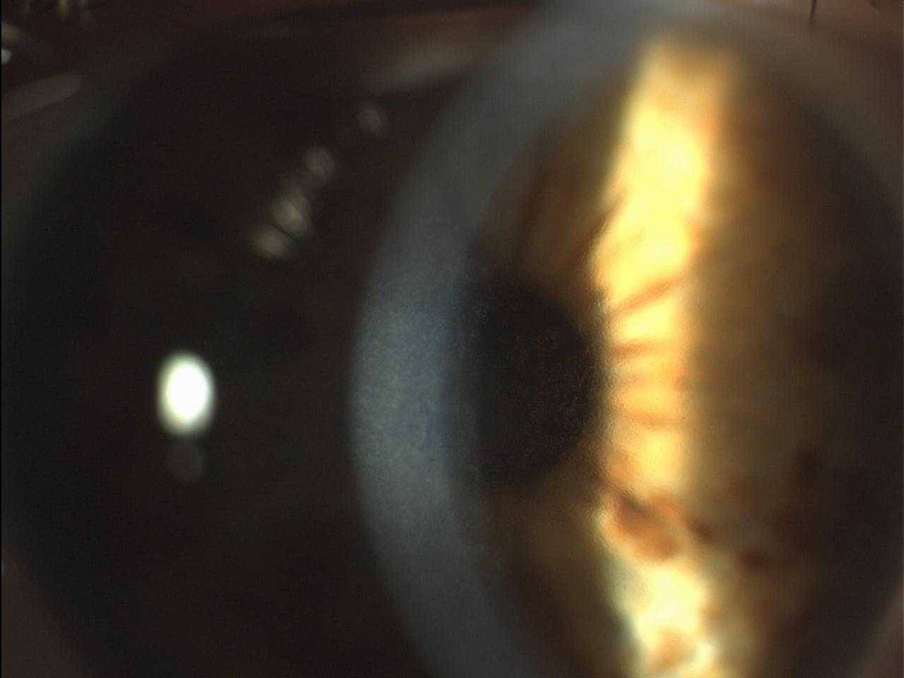 Figura 10: Iniziale edema corneale centrale in Distrofia endoteliale di Fuchs