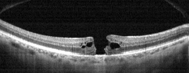 Figura 1 Scansione OCT del polo posteriore con evidenza di foro maculare a tutto spessore