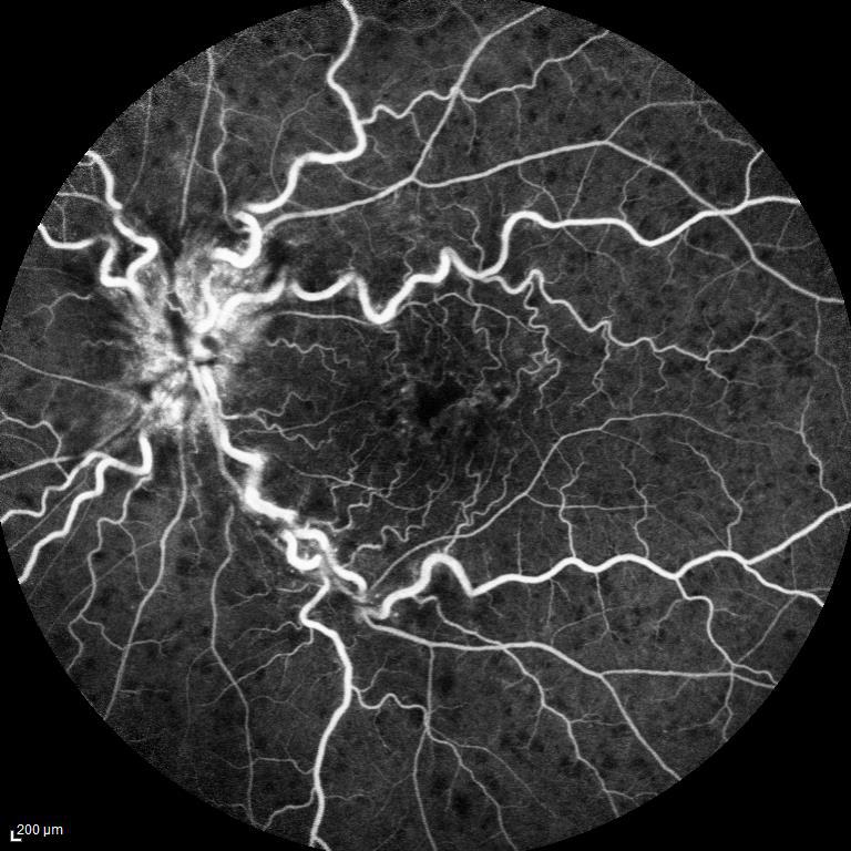 occlusioni venose retiniche Immagine fluorangiografica di CRVO con evidenza di dilatazione venosa, emorragie sparse ed edema maculare e della papilla ottica
