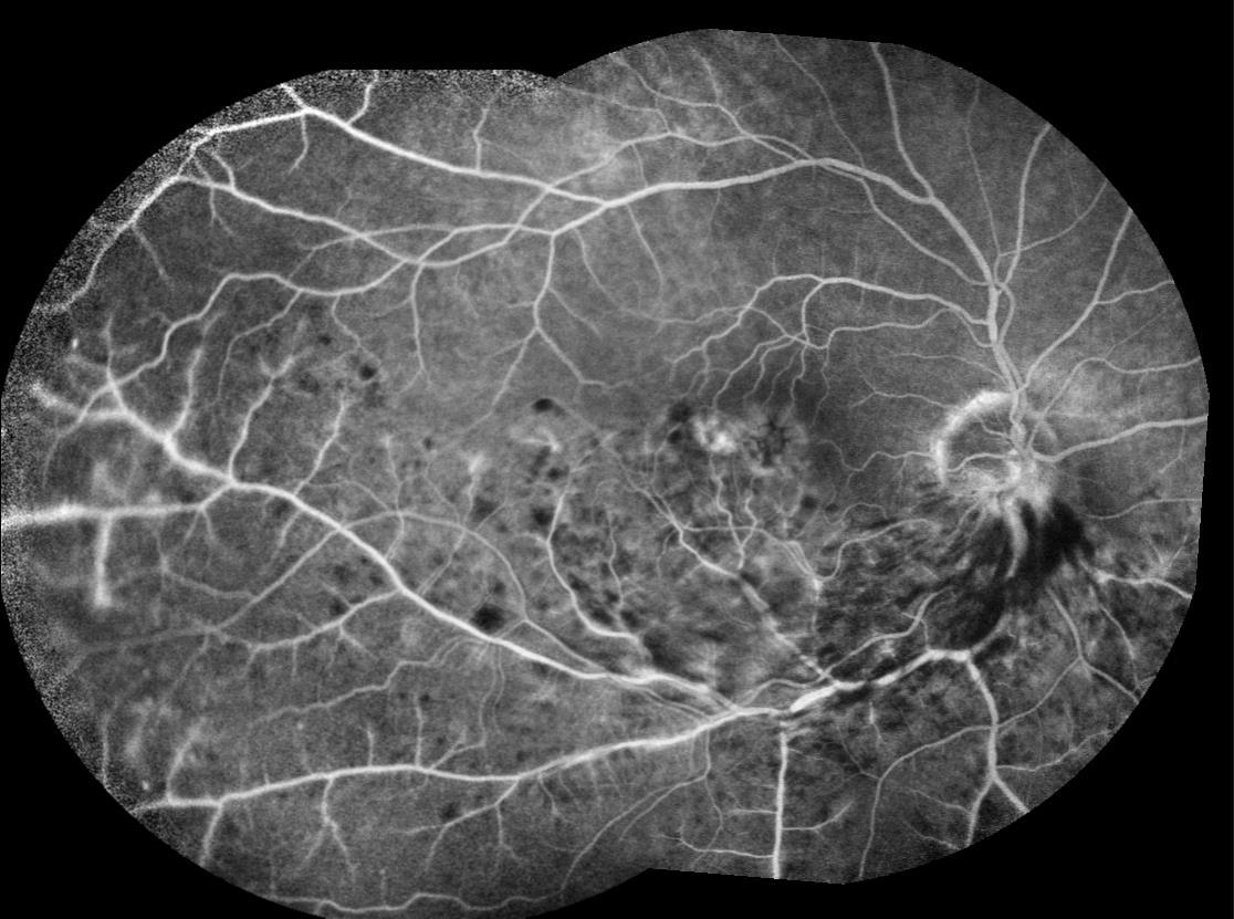 occlusioni venose retiniche Immagine fluorangiografica che evidenzia BRVO con aree di emorragia ed edema maculare