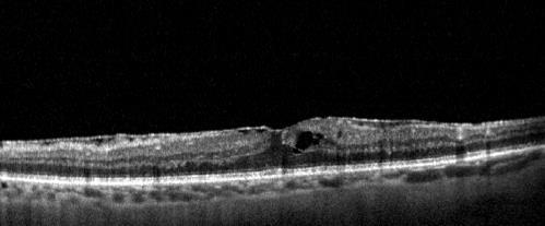 retina chirurgica Scansione OCT maculare con evidenza di membrana epiretinica ed iniziale edema intraretinico