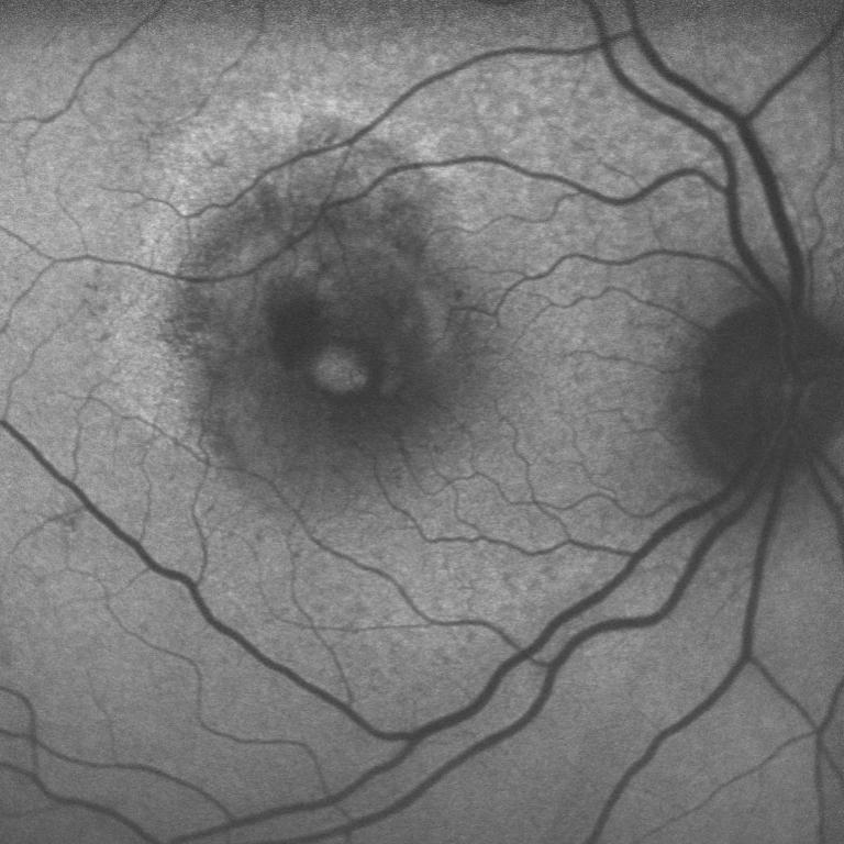 retina chirurgica Immagine in autofluorescenza di foro maculare