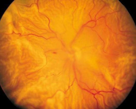 retina chirurgica Distacco di retina totale