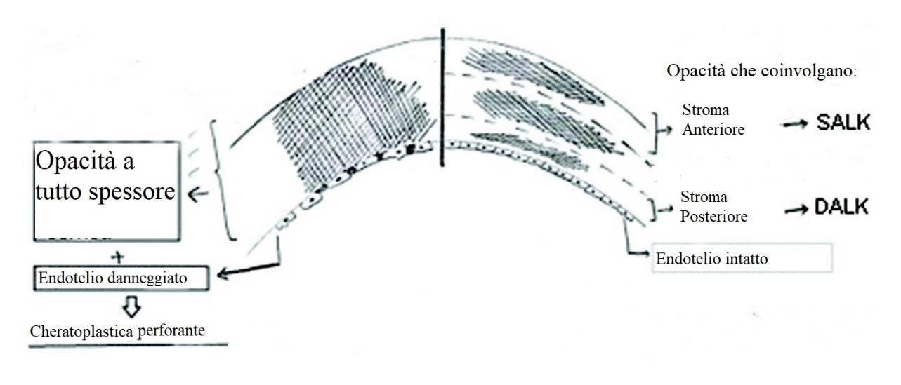 cheratoplastica Illustrazione riassuntiva delle indicazioni delle varie cheratoplastiche