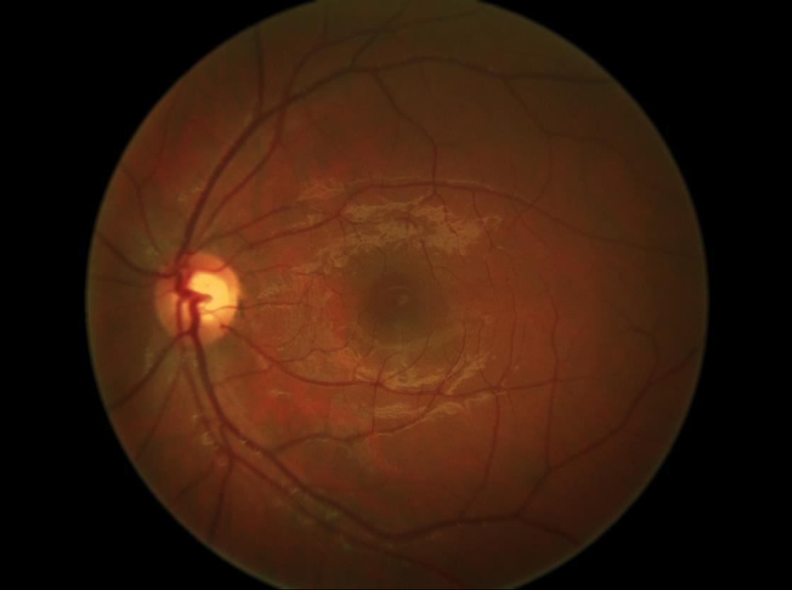 Glaucoma Papilla ottica