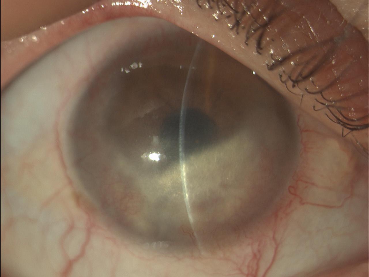 Cheratite stromale con degenerazione lipidica in malattia erpetica oculare