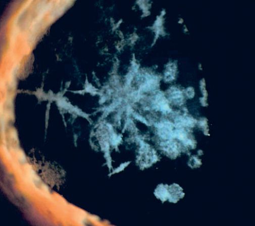 Figura 8: Distrofia granulare di tipo II (Avellino)