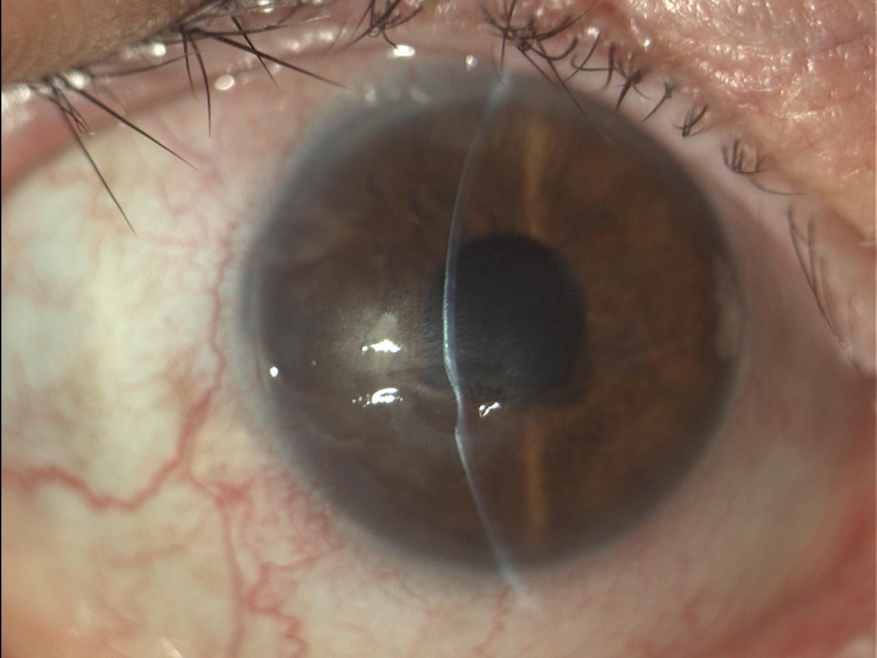 Figura 5 Ulcera corneale sterile in paziente affetto da occhio secco e Sindrome di Sjogren