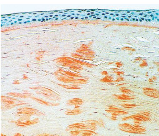 Figura 5: L’istologia evidenzia l’amiloide colorata con rosso Congo