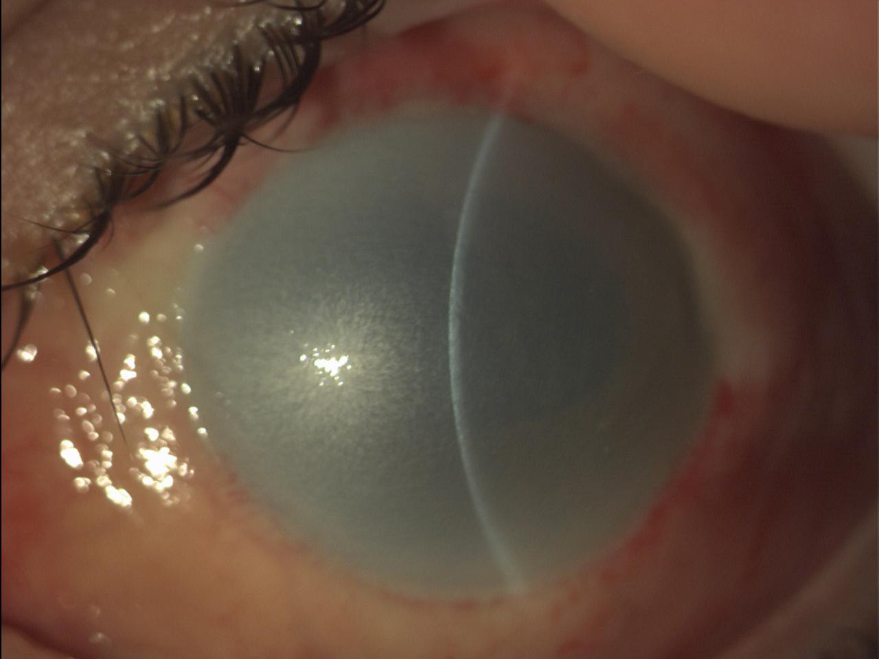 Figura 2 Disepitelizzazione ed opacità corneale diffusa in paziente affetto da ustione da alcali