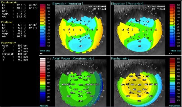 Figura 5 Tomografia corneale con rappresentazione delle mappe di curvatura ed altimetriche in paziente normale