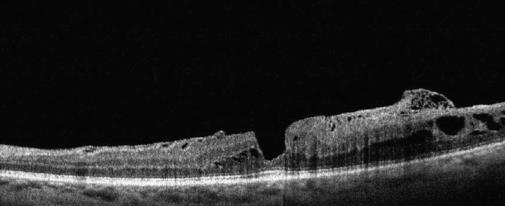 retina chirurgica Scansione OCT del polo posteriore con evidenza di membrana epiretinica e foro lamellare