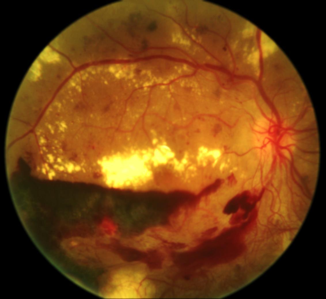 retinopatia diabetica Immagine del fondo oculare di retinopatia proliferante con neovasi papillari, vasta area di emorragie e numerosi essudati duri